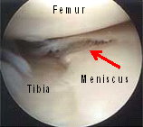 Meniscal tears